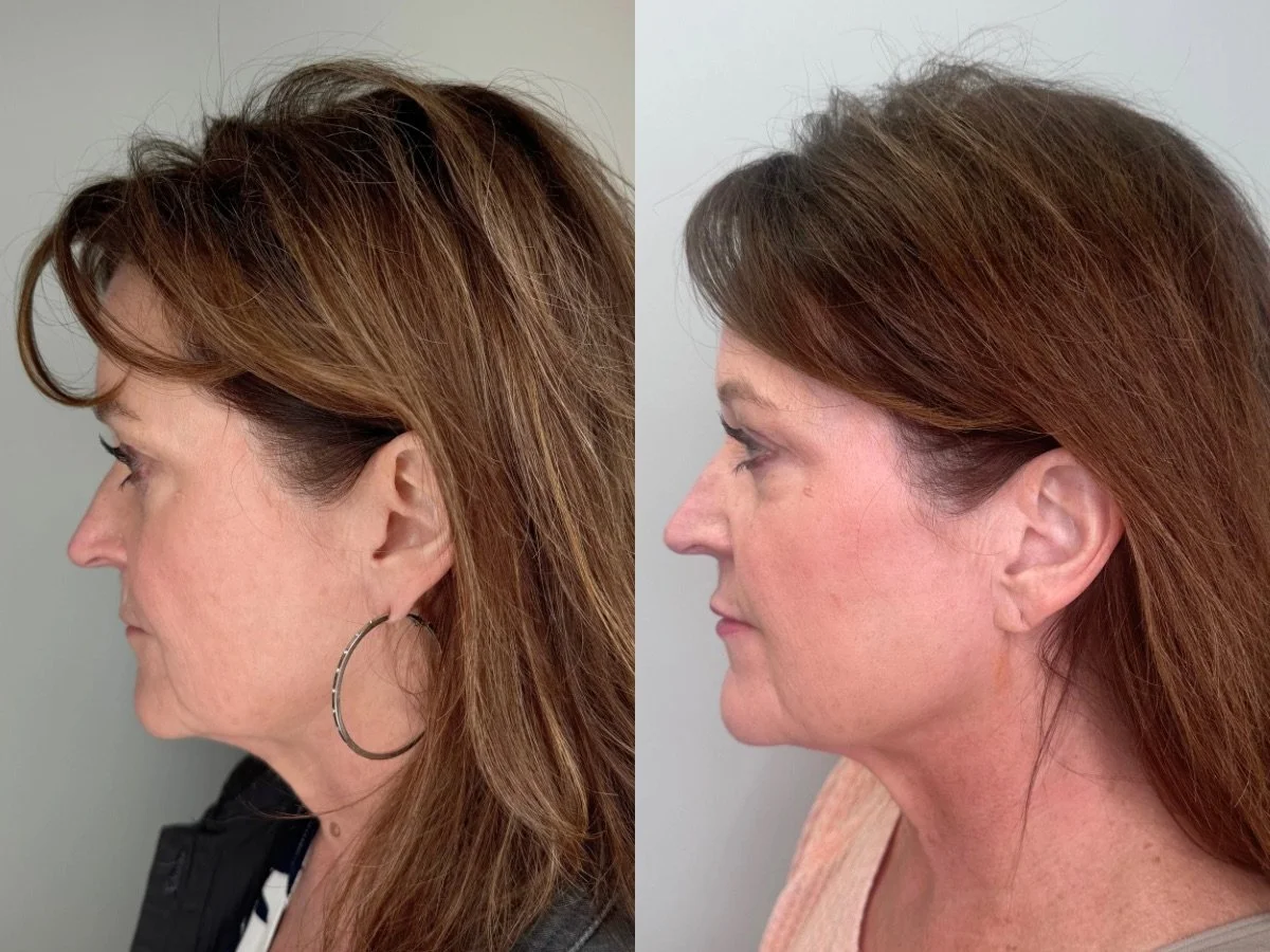 Emface Non-Surgical Face Lift, Mankato 