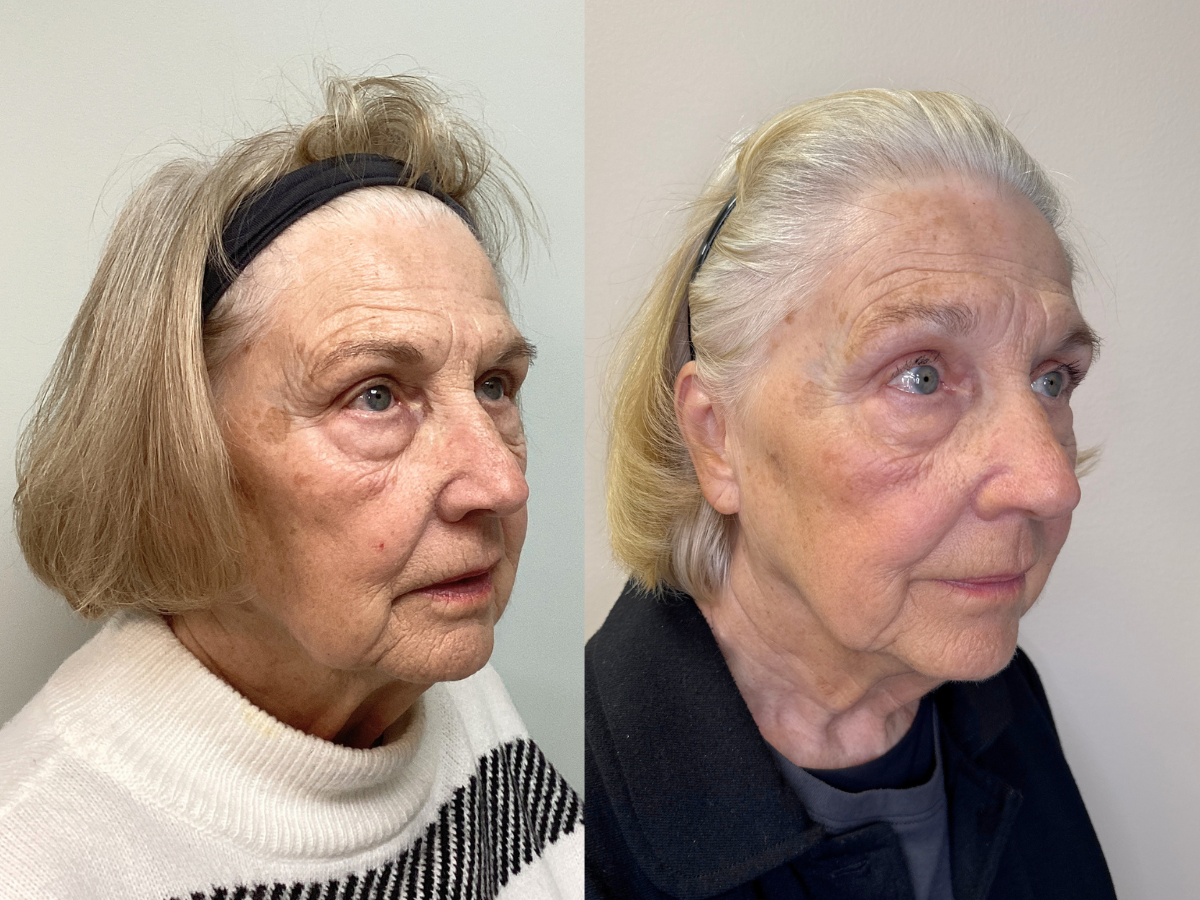 Side by side comparison of an elderly woman before and after cosmetic treatment, showing improved skin texture and less wrinkles.