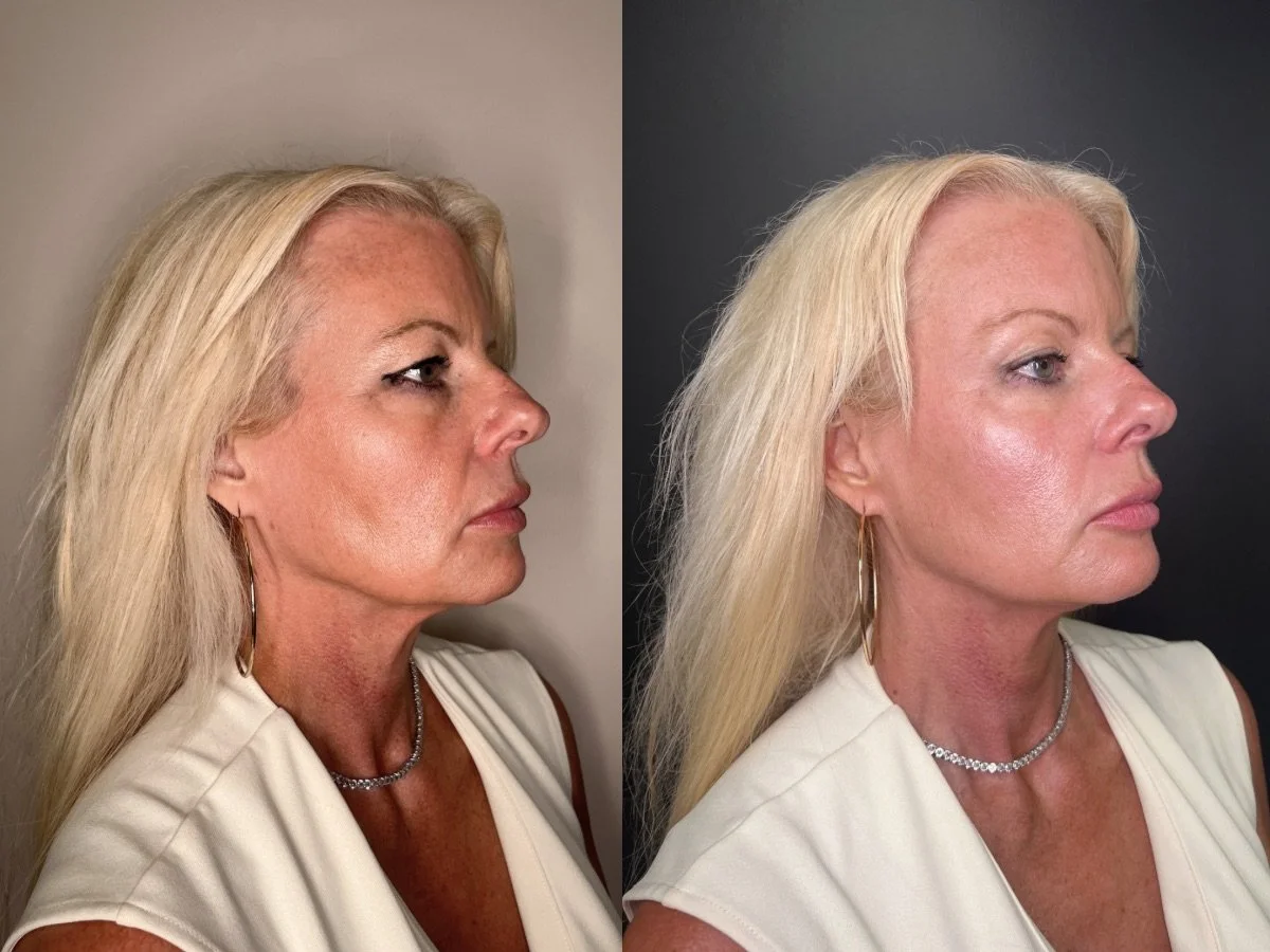 Dermal Filler Mankato, MN The Skin Clinic