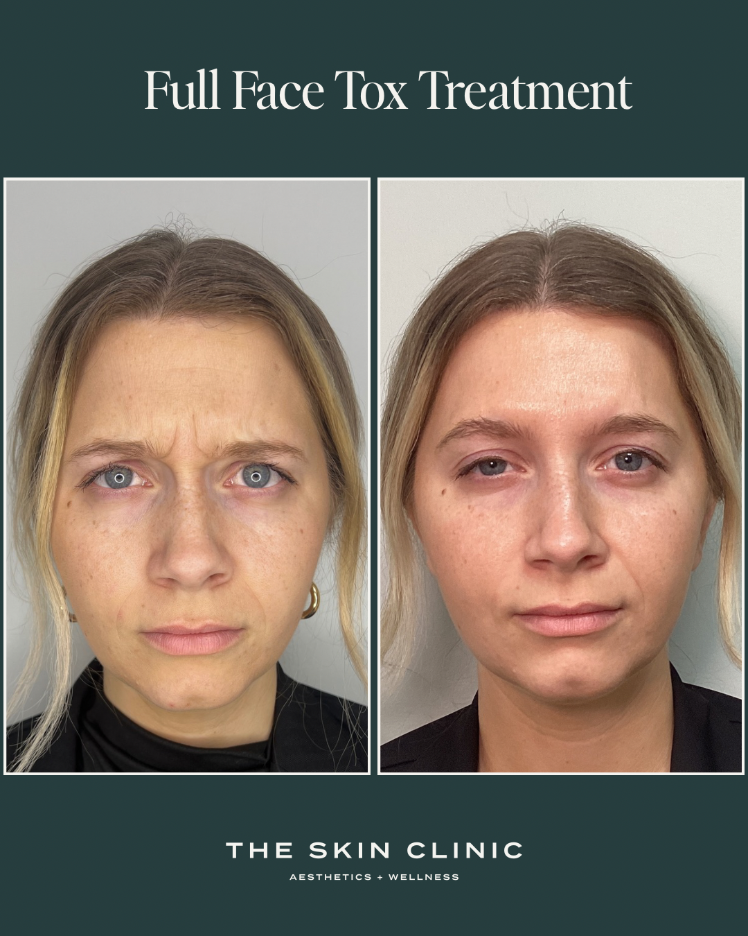 Side-by-side comparison of a woman's face before and after full face toxin treatment, showing smoother skin and reduced wrinkles.