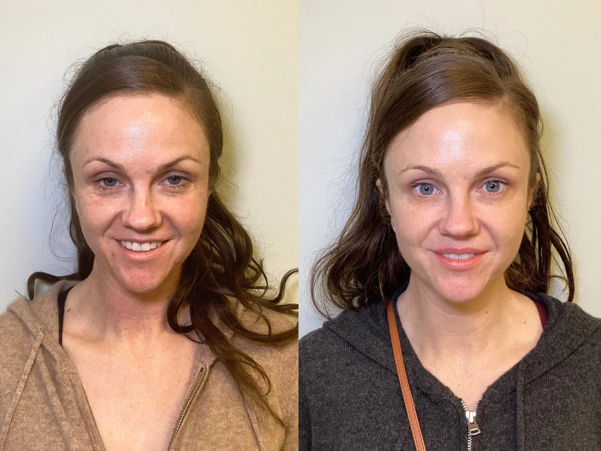 Botox Treatment