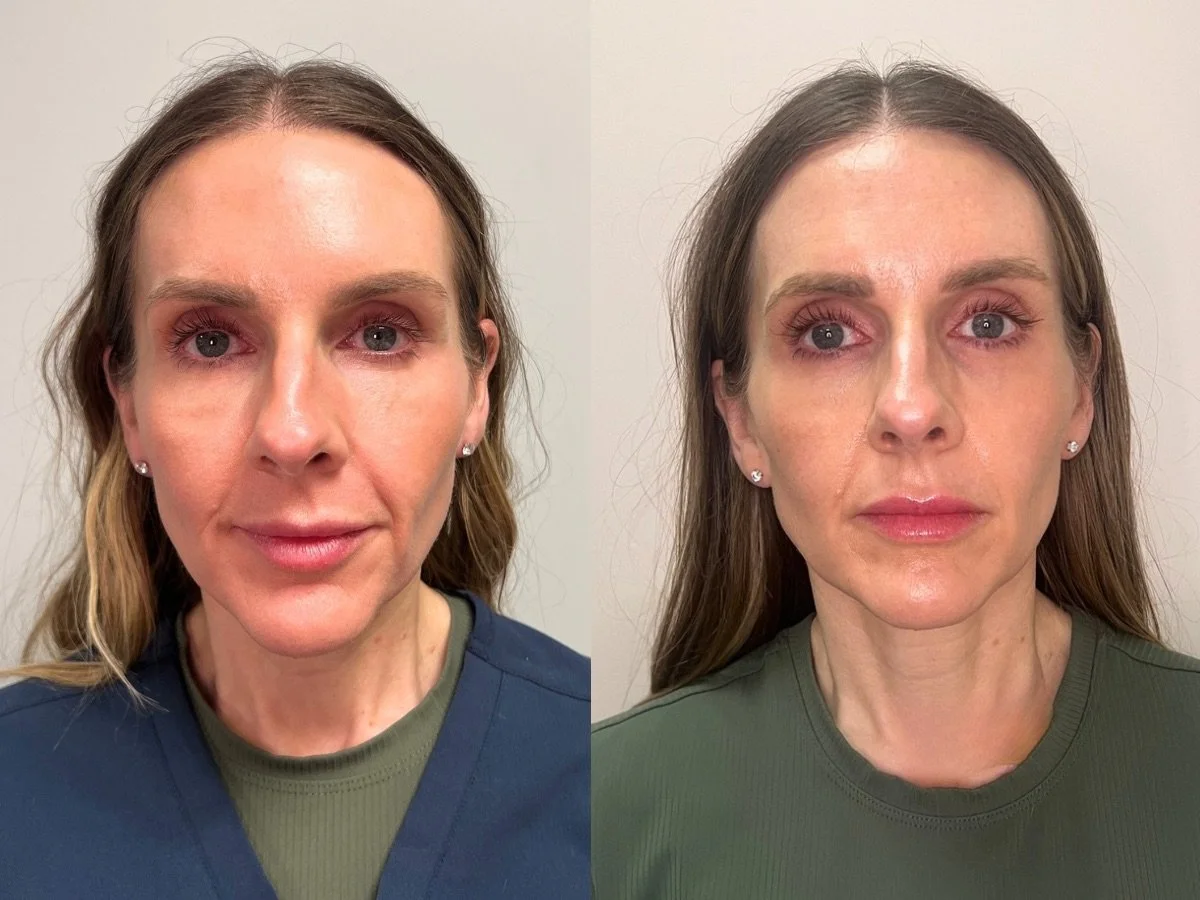 Emface Non Surgical Facelift, the skin clinic, Mankato