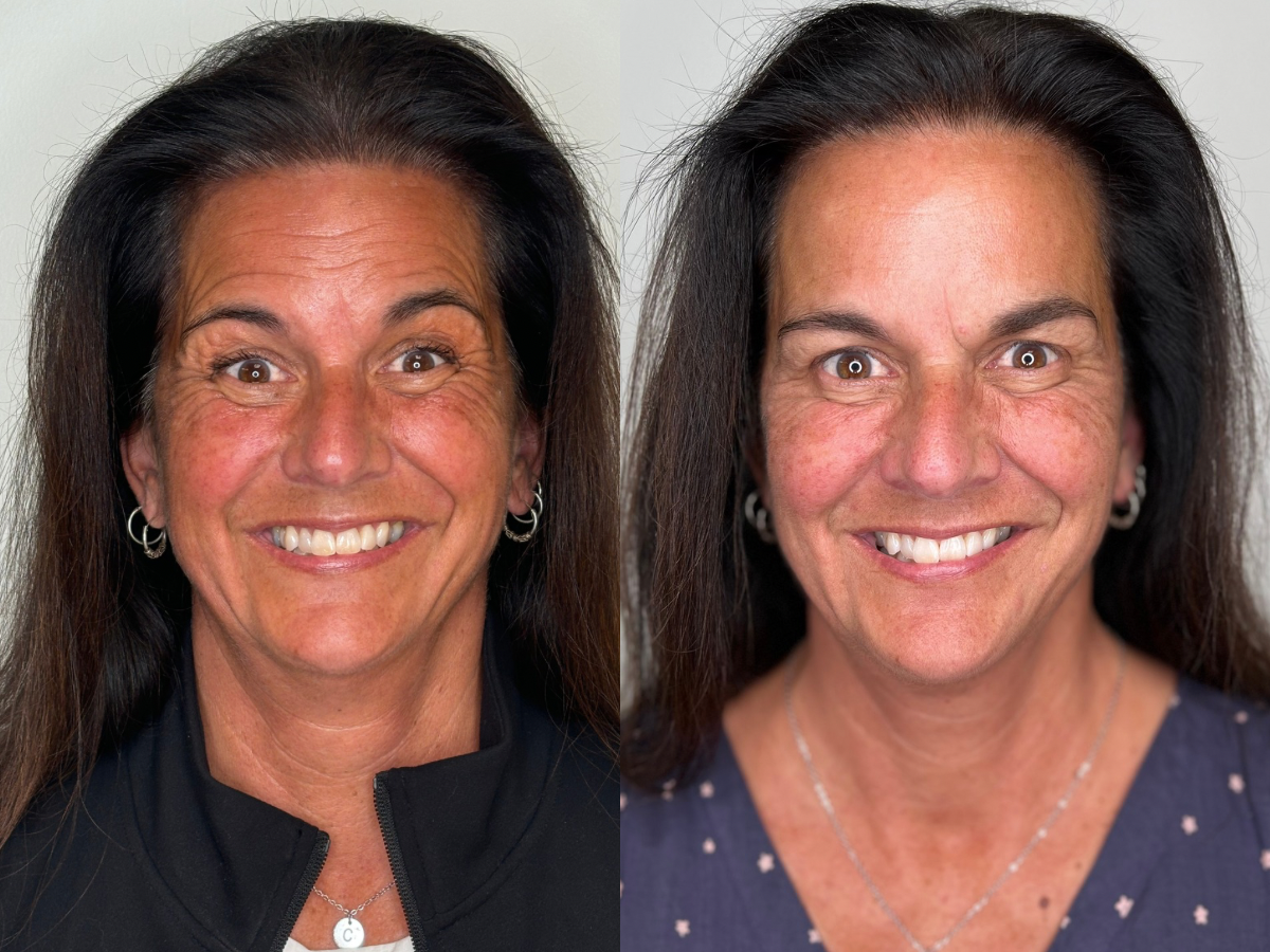 Botox Treatment