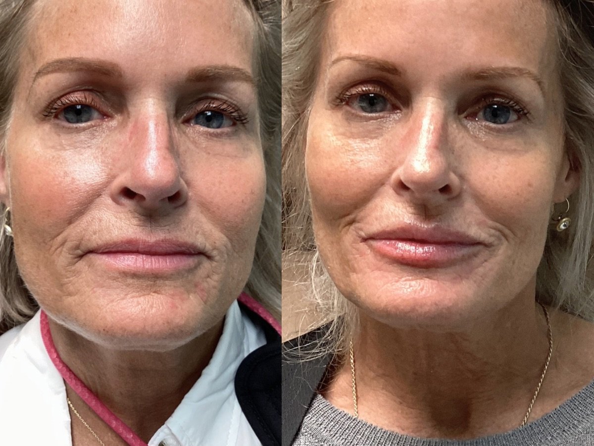 Lip Filler 