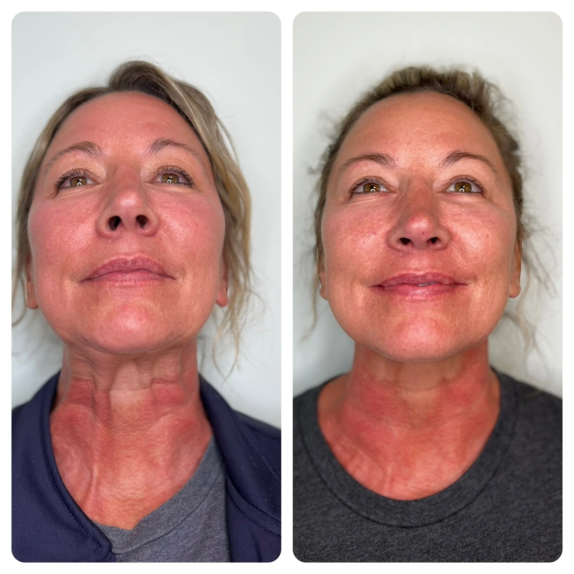 Comparison of a woman's face before and after a cosmetic treatment, showing reduced redness and improved skin texture.