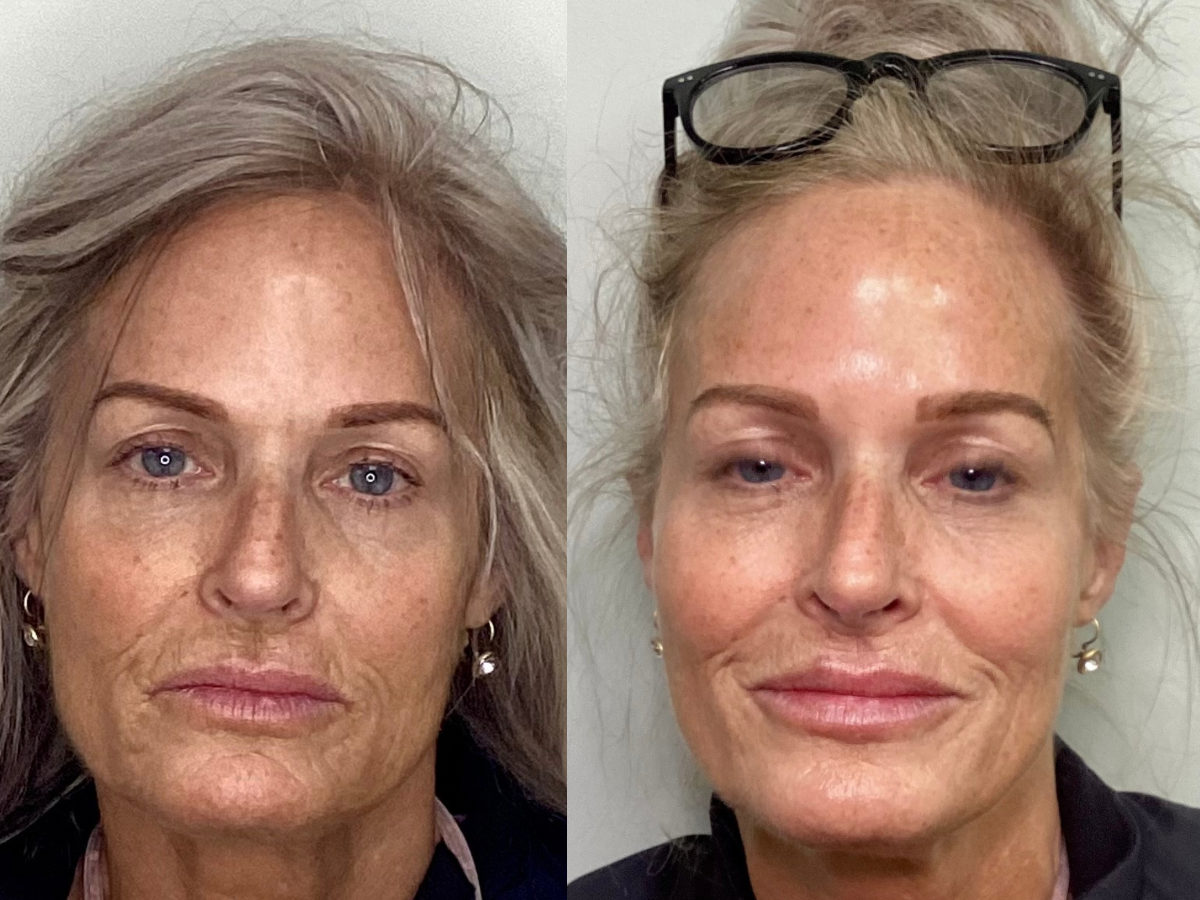 Dermal Filler, Lip Filler Treatment, Mankato, MN