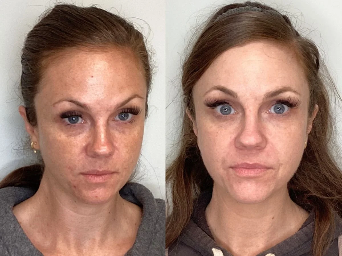 C02 Laser Treatment at the Skin Clinic Med Spa, Mankato, Mn