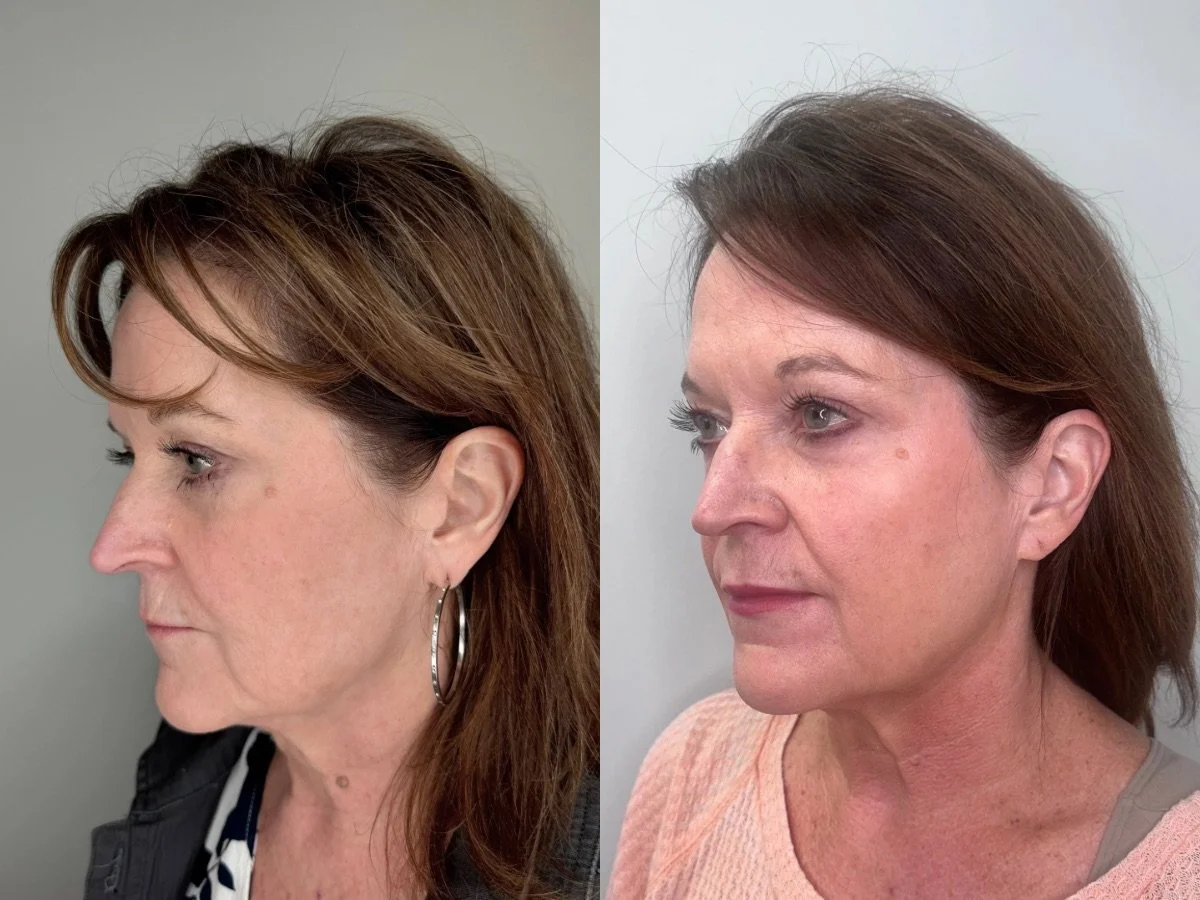Emface Non Surgical Facelift, the skin clinic, Mankato