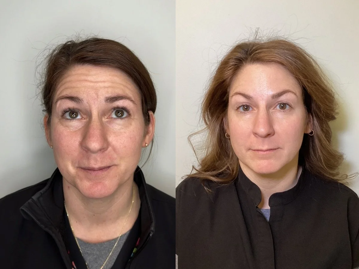 Side-by-side comparison of a person's smile before and after toxin treatment for gummy smile, showing improved gum coverage and more even teeth.