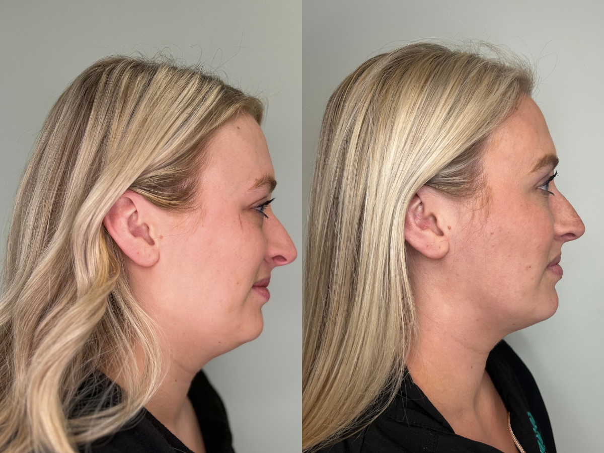 Side-by-side comparison of a woman's profile showing the before and after results of a cosmetic procedure on her nose and facial features, with blonde hair and a black top.