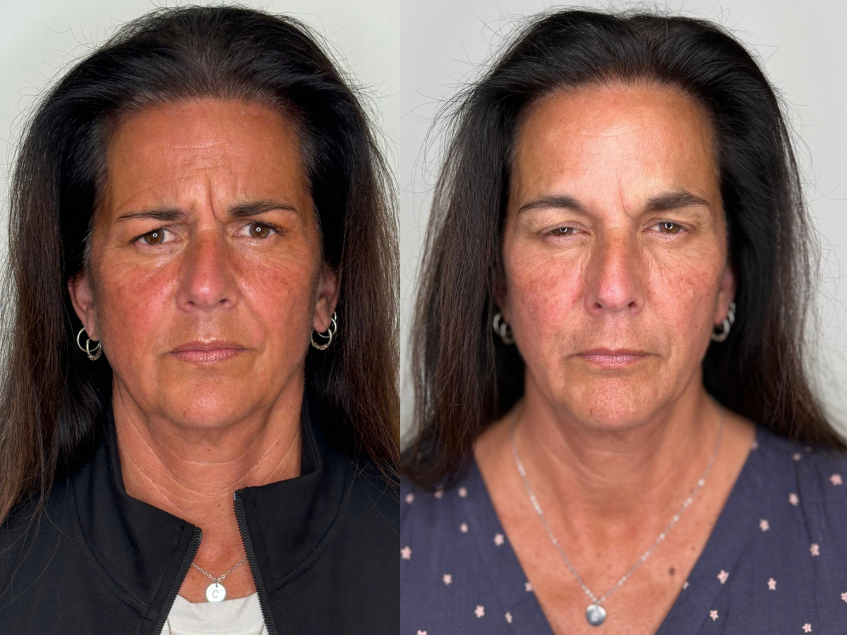 Botox before and after first treatment 