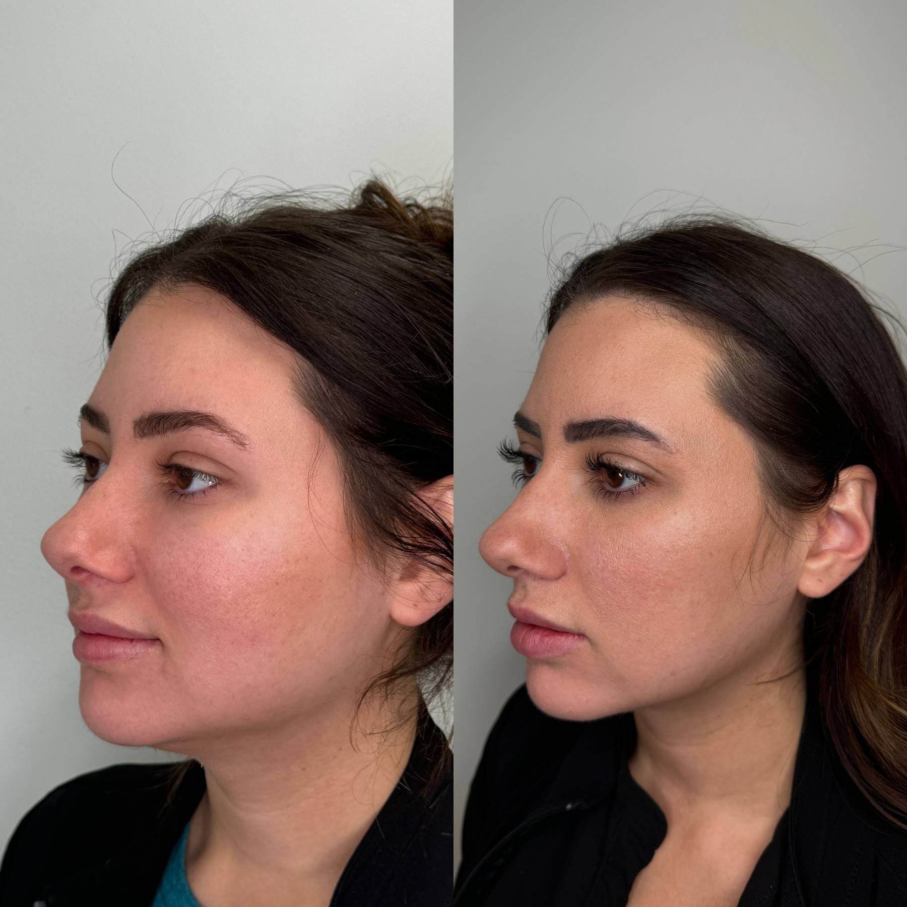 Comparison of a woman's face before and after a cosmetic treatment, showing smoother skin and refined features on the right.