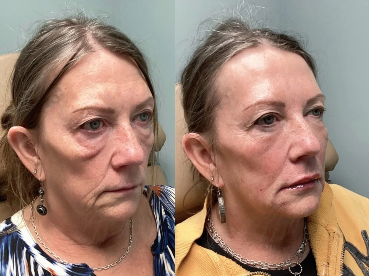 Dermal Filler Mankato, MN The Skin Clinic