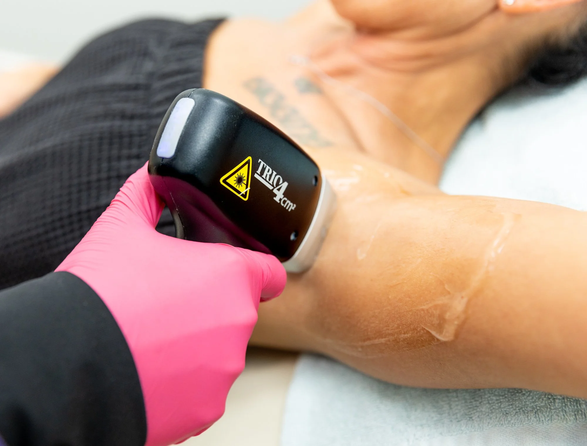 A person using a laser hair removal device on their underarm with a gloved hand, showing the device emitting laser pulses.