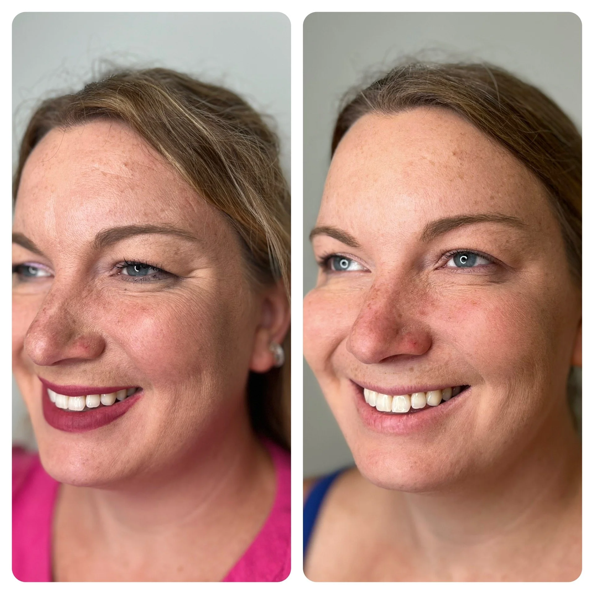 Botox treatment 
