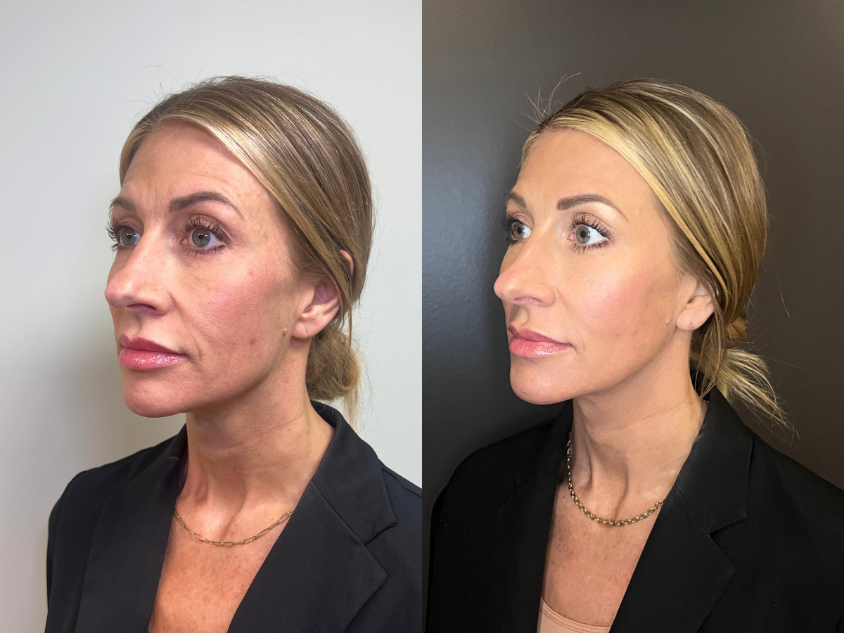 Side profile of a woman with dark brown hair, showing slight hair thinning before and after hair restoration.