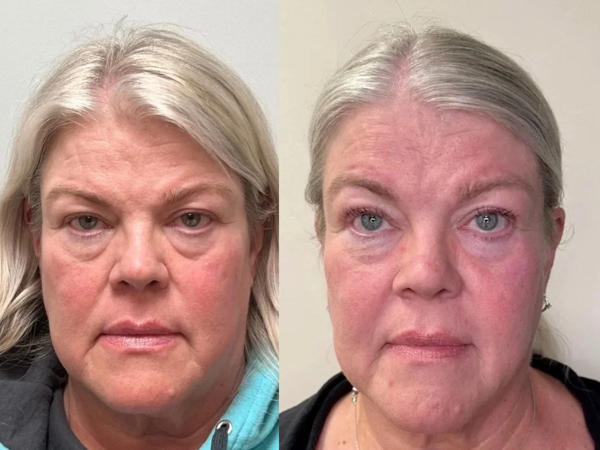 Emface Treatment Mankato, Mn