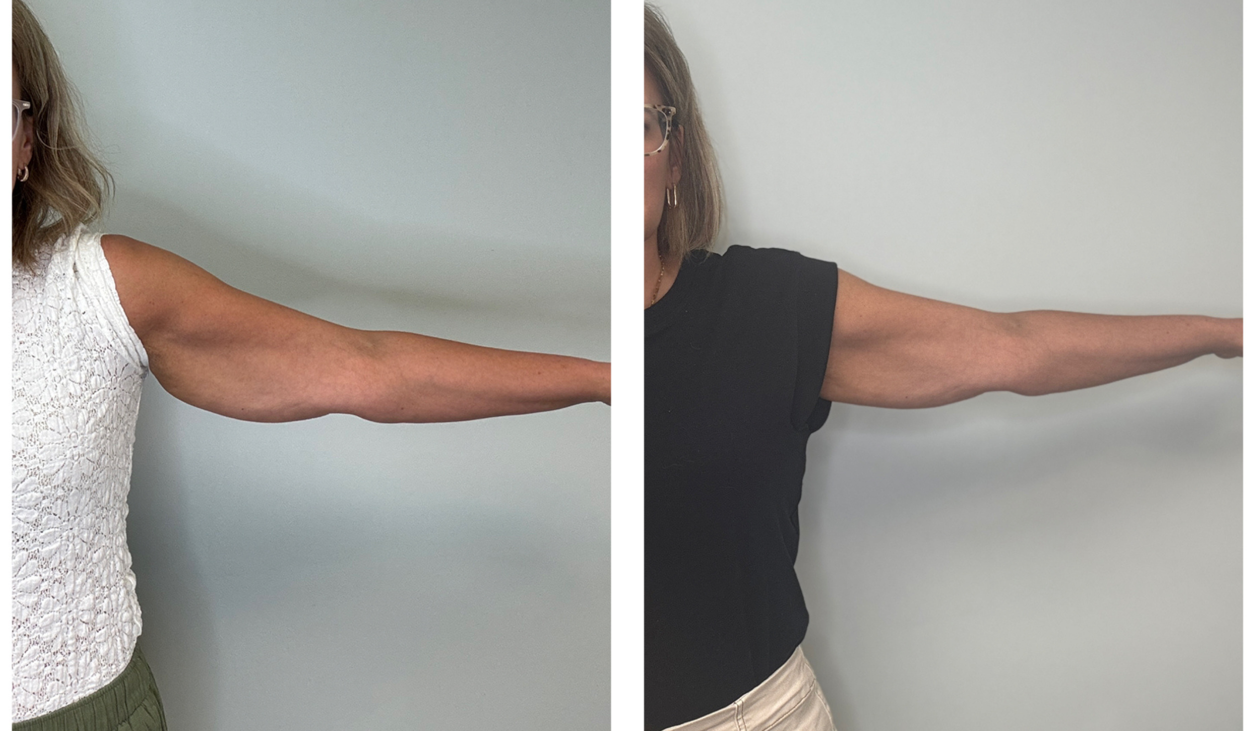 Comparison of two women showing their outstretched arms in front of a plain white wall, one wearing a white sleeveless top and the other wearing a black t-shirt.