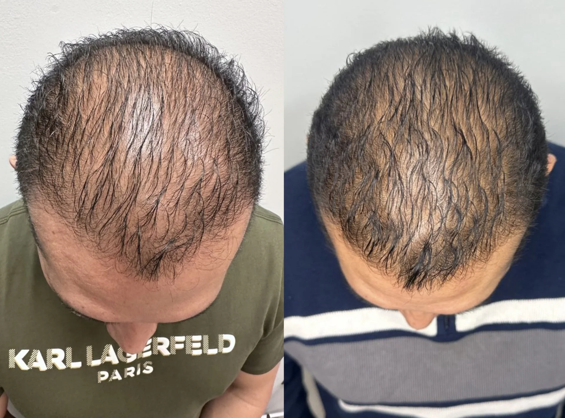 Comparison of a man's top-view before and after hair restoration treatment, showing increased hair_density and coverage.