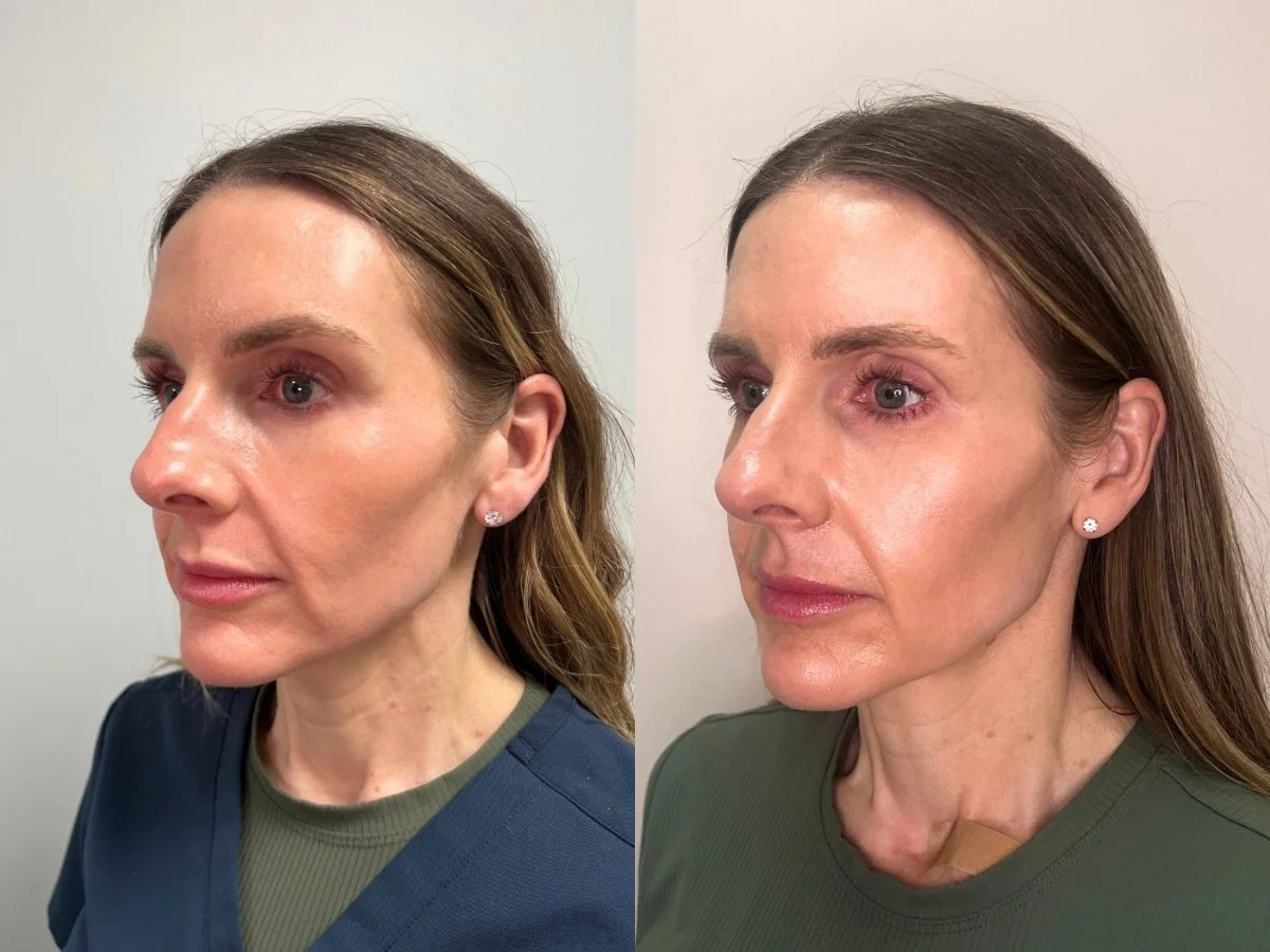 Dermal Filler Mankato, MN The Skin Clinic