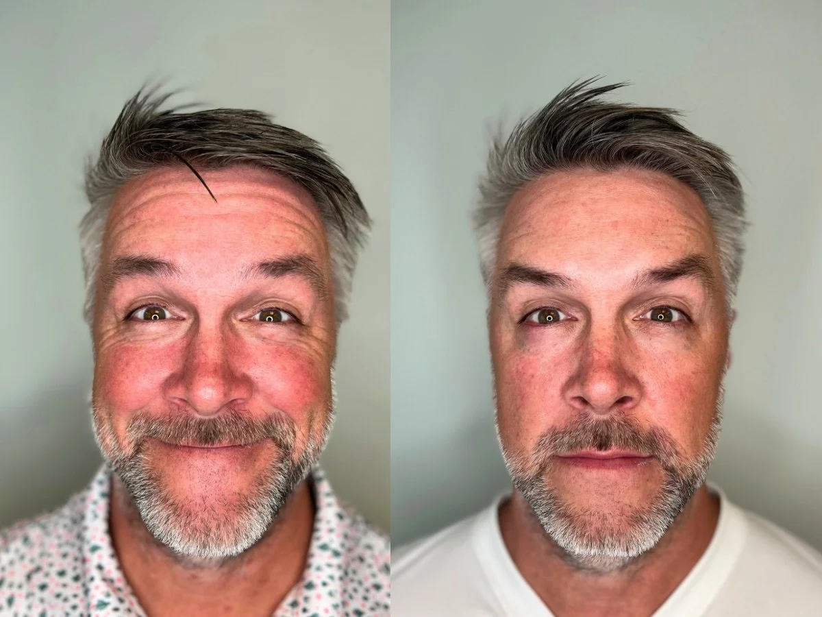 Dermal Filler, Lip Filler Treatment, Mankato, MN