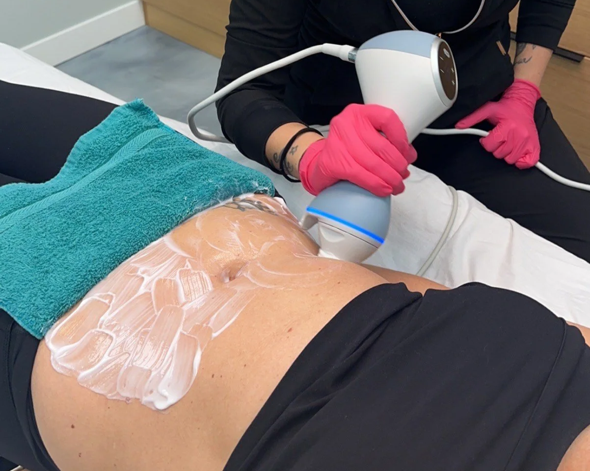 A person receiving a cosmetic or dermatological treatment on their abdomen with a handheld device, while a technician wearing pink gloves and black attire operates the equipment.