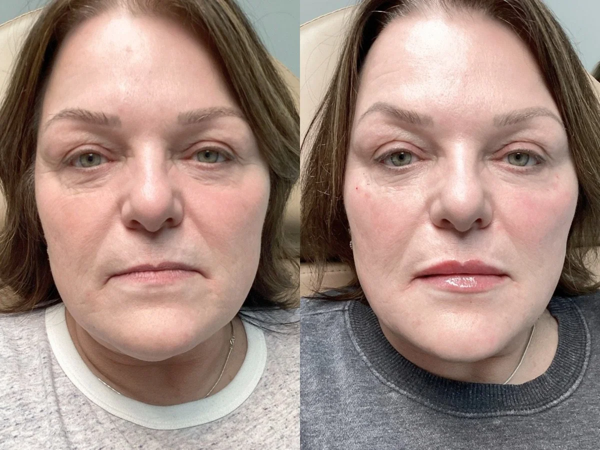 Lip Filler Mankato, Mn