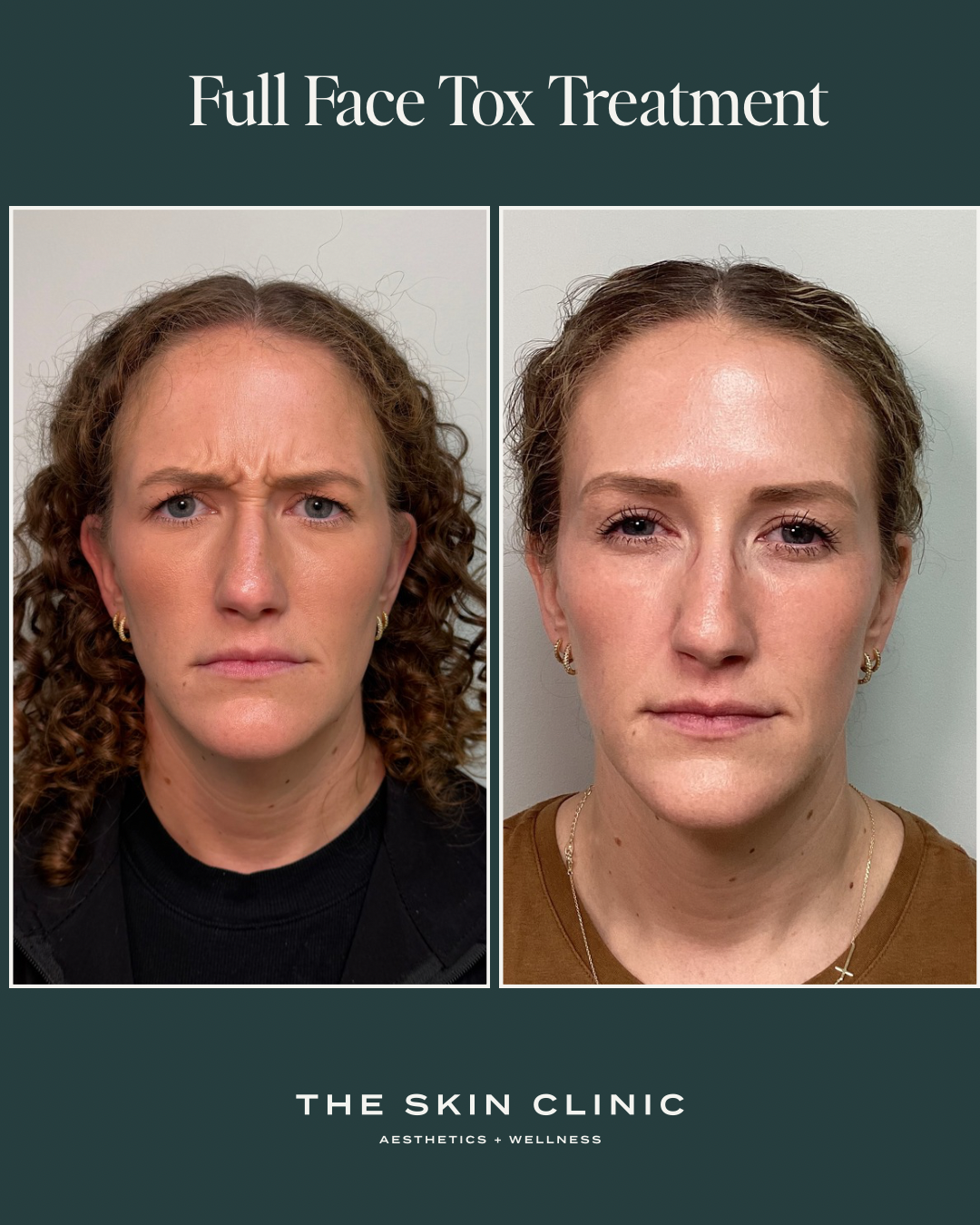 Botox Treatment 