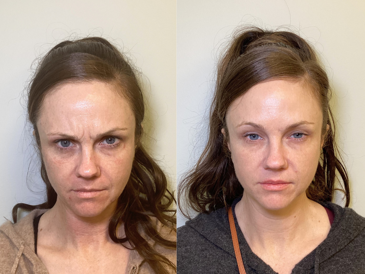 Side-by-side comparison of a woman with third-degree burns on her face and a woman with healed skin, showing the healing process.