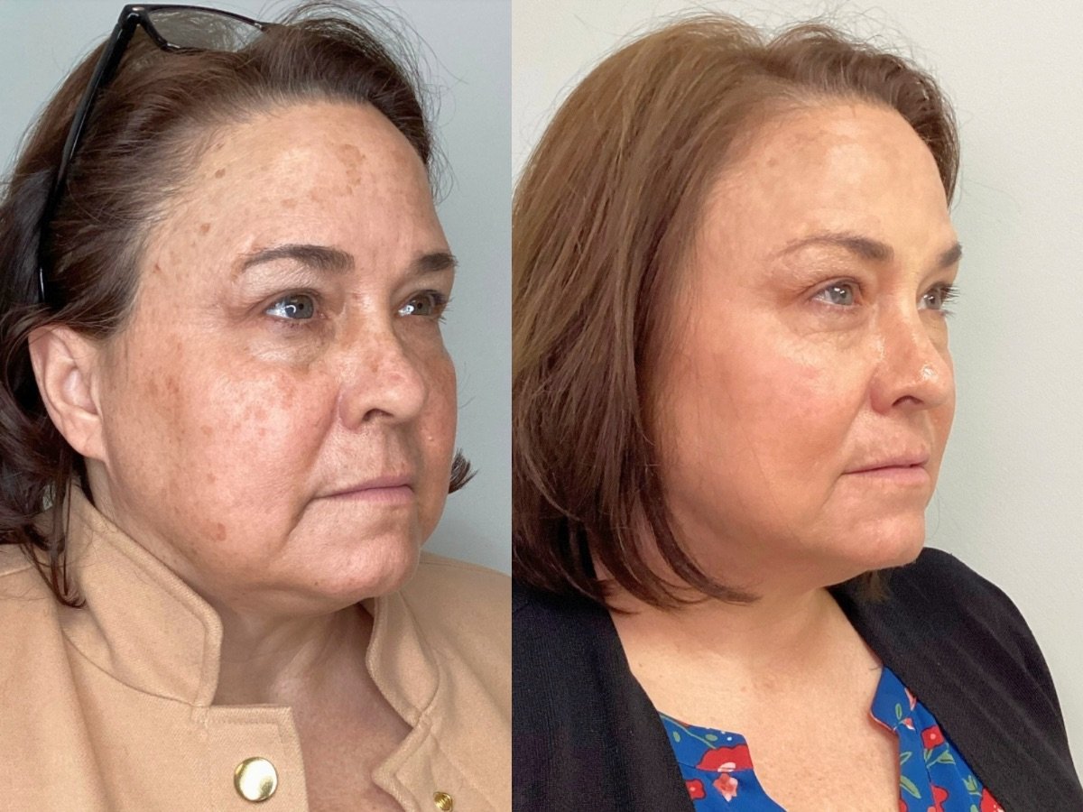 IPL BBL PHOTOFACIAL Mankato, mn