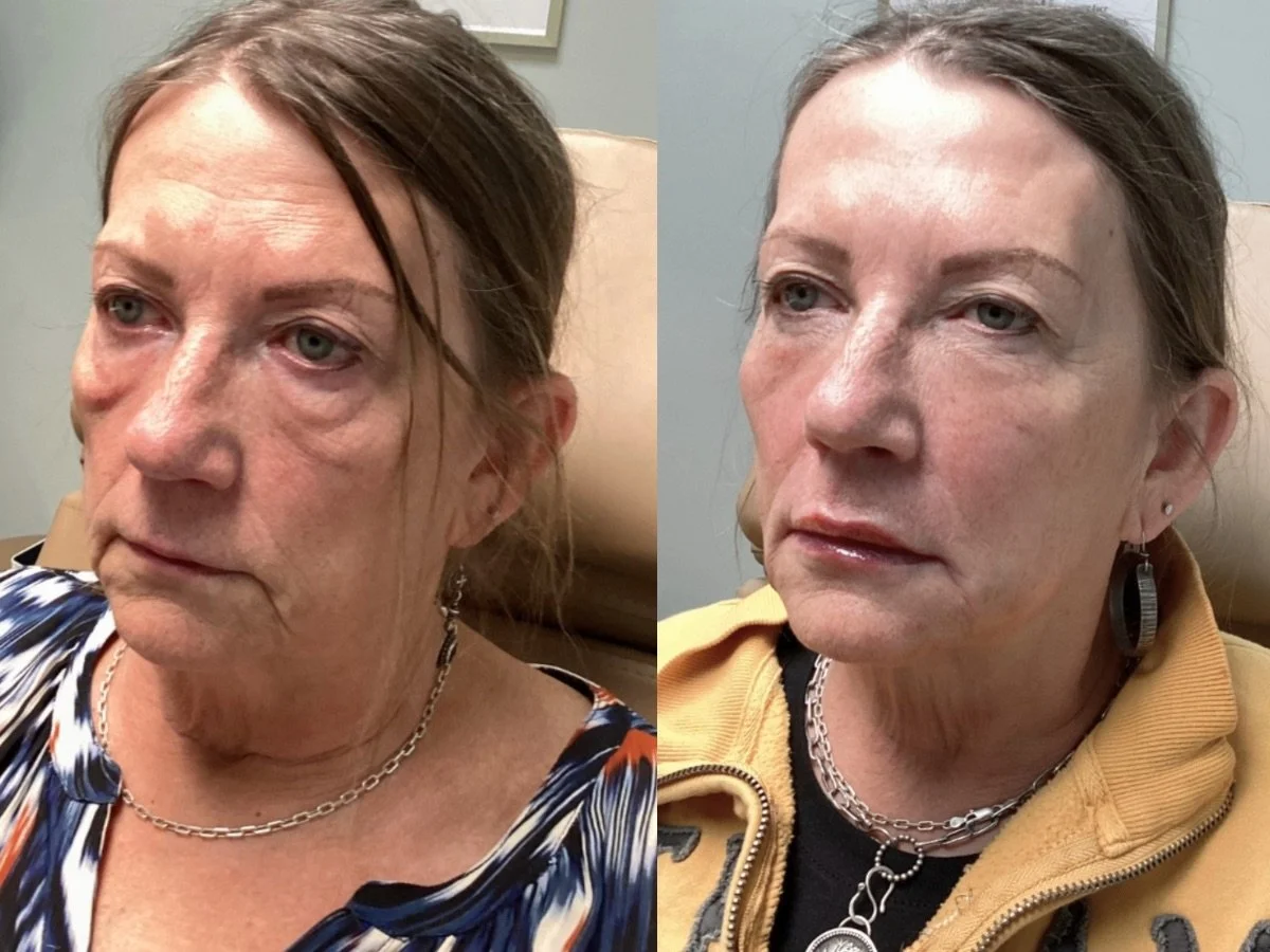 Dermal Filler Mankato, MN The Skin Clinic