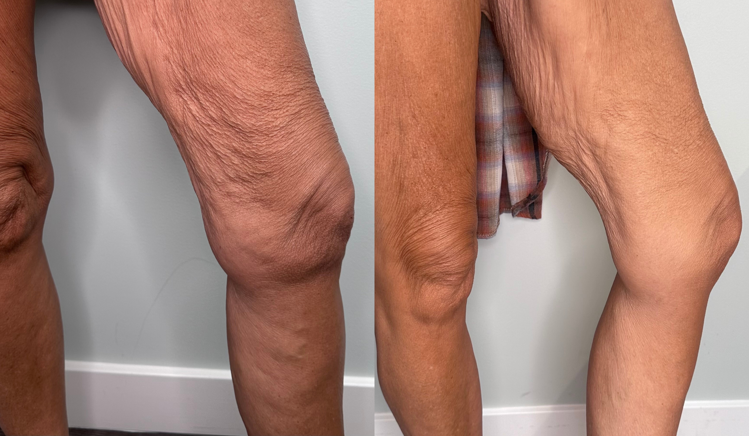 Comparison of a person's wrinkled, aged skin on the left with smoother, younger-looking skin on the right, wearing plaid shorts.