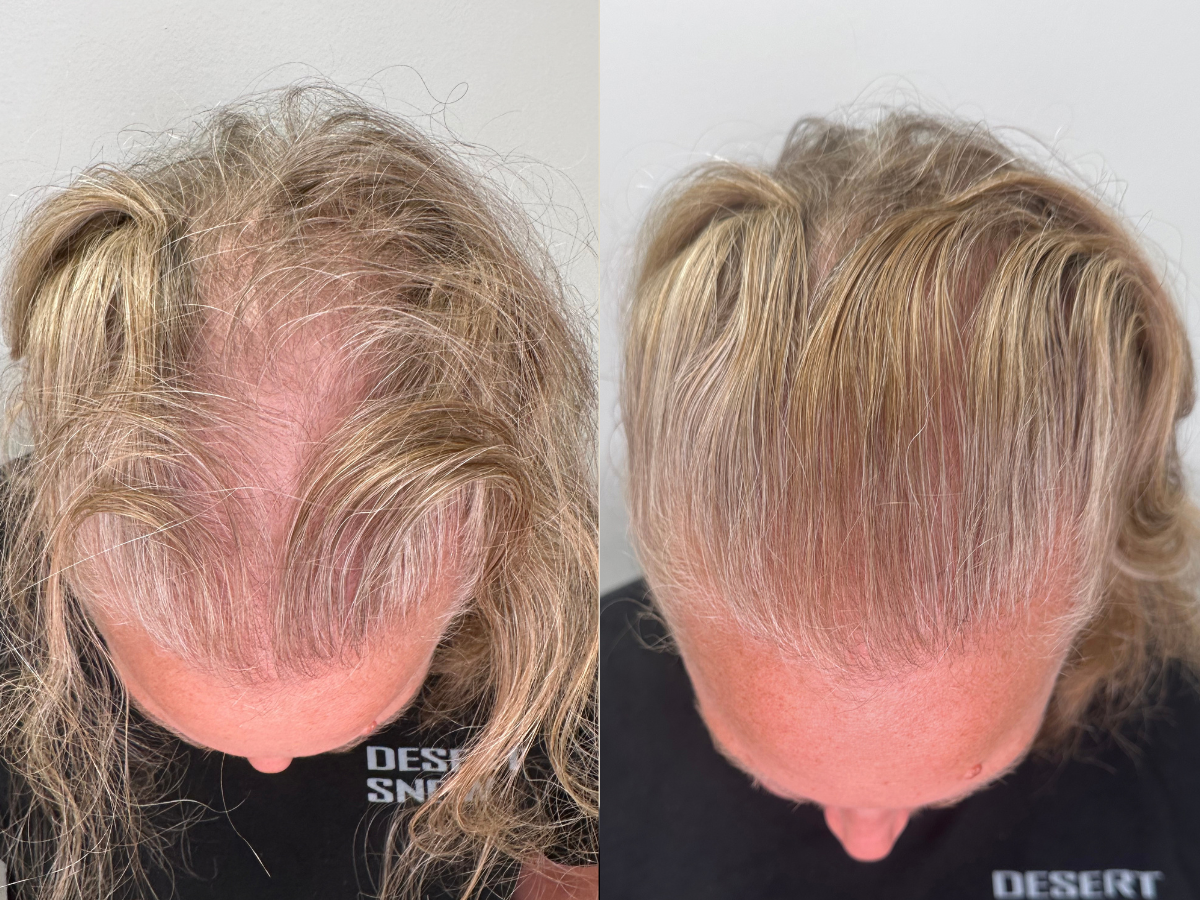 Side-by-side comparison of a person's scalp before and after hair styling, showing improved hair density and neatness after treatment.