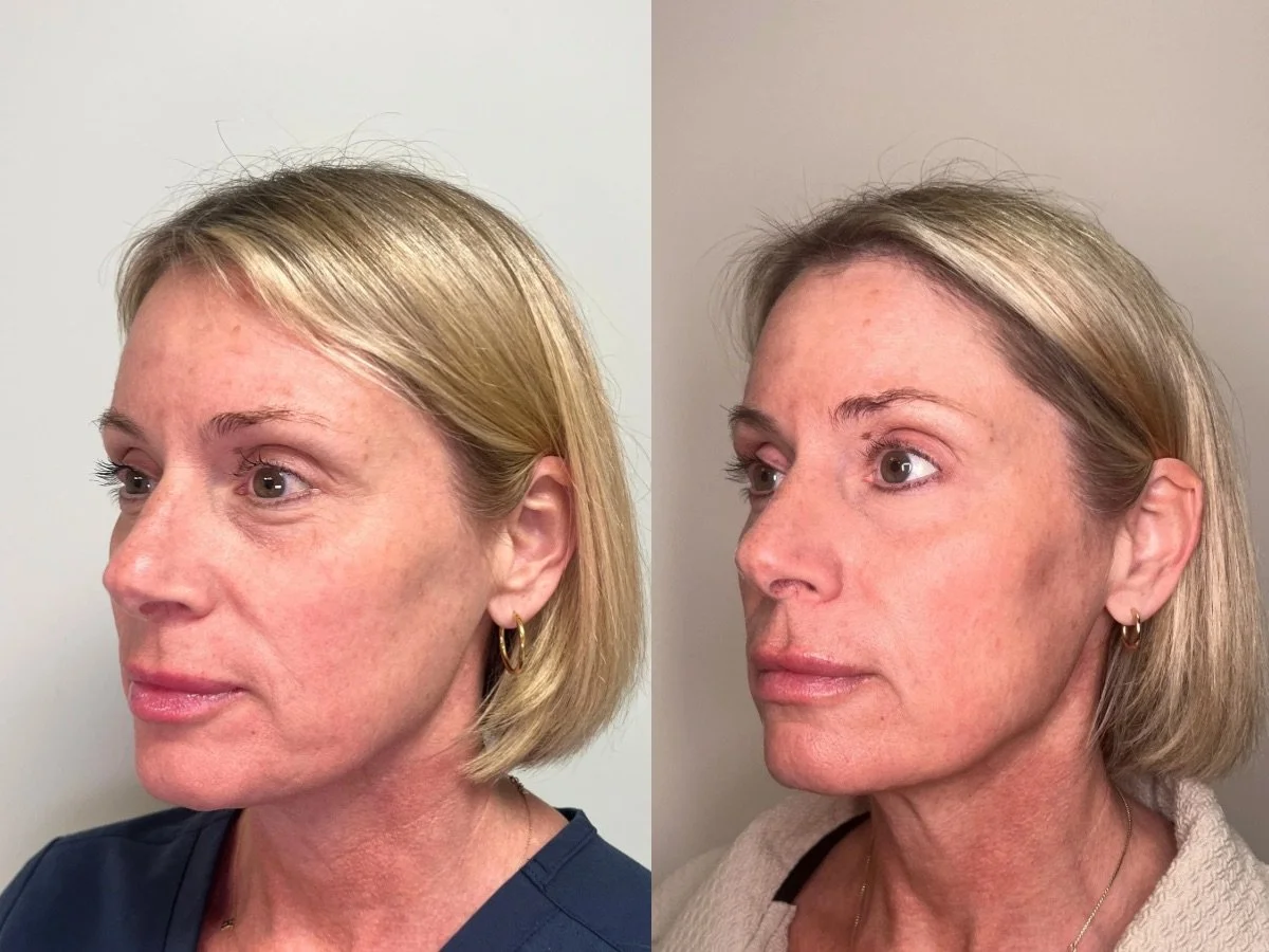 Emface Non Surgical Facelift, the skin clinic, Mankato