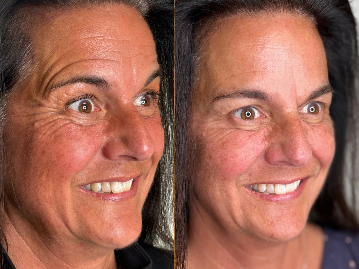 Botox treatment-eye wrinkles