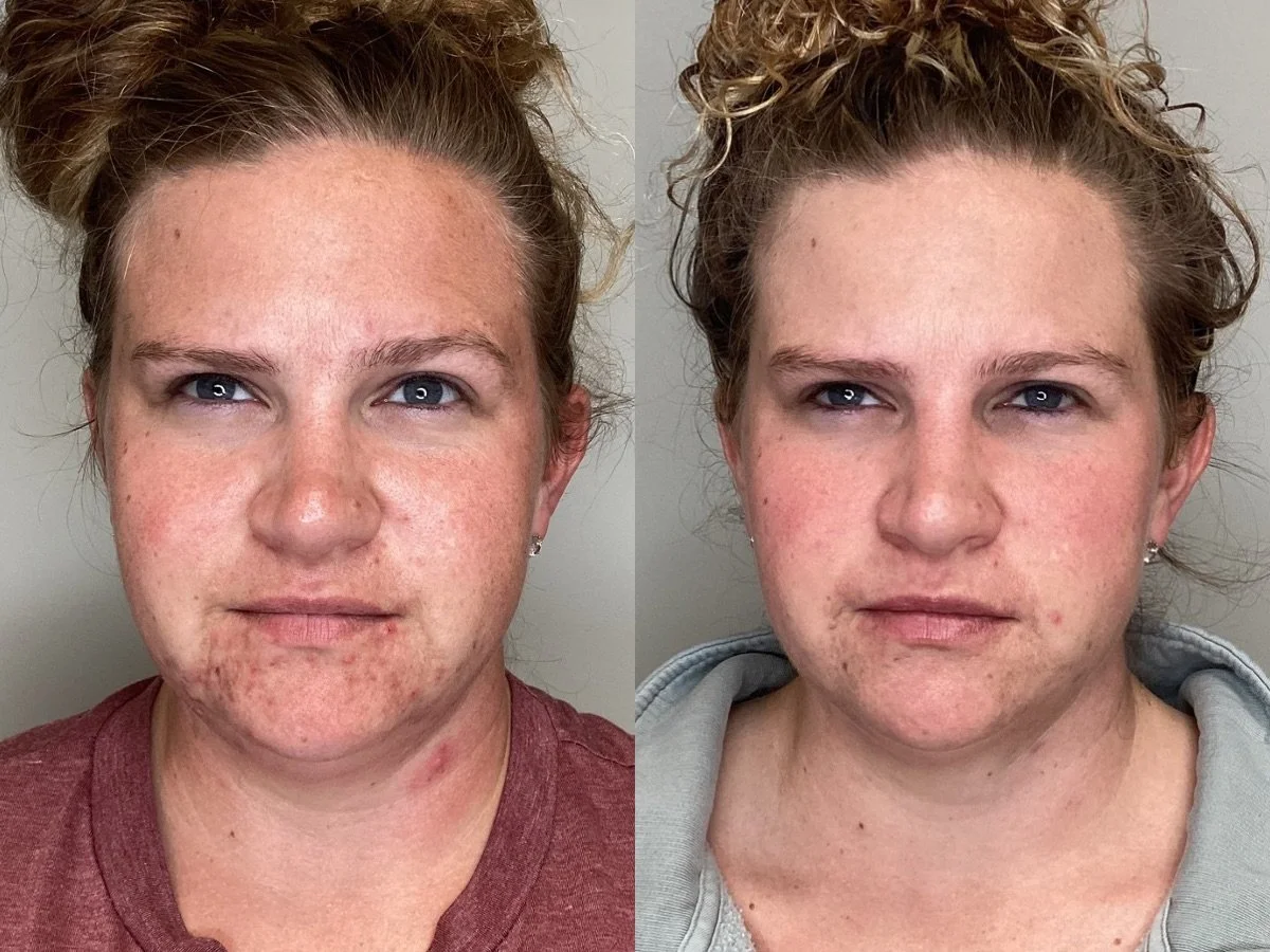 Before and after photos of a woman showing skin improvement, with the left image depicting her with more facial redness and acne, and the right image showing clearer skin.