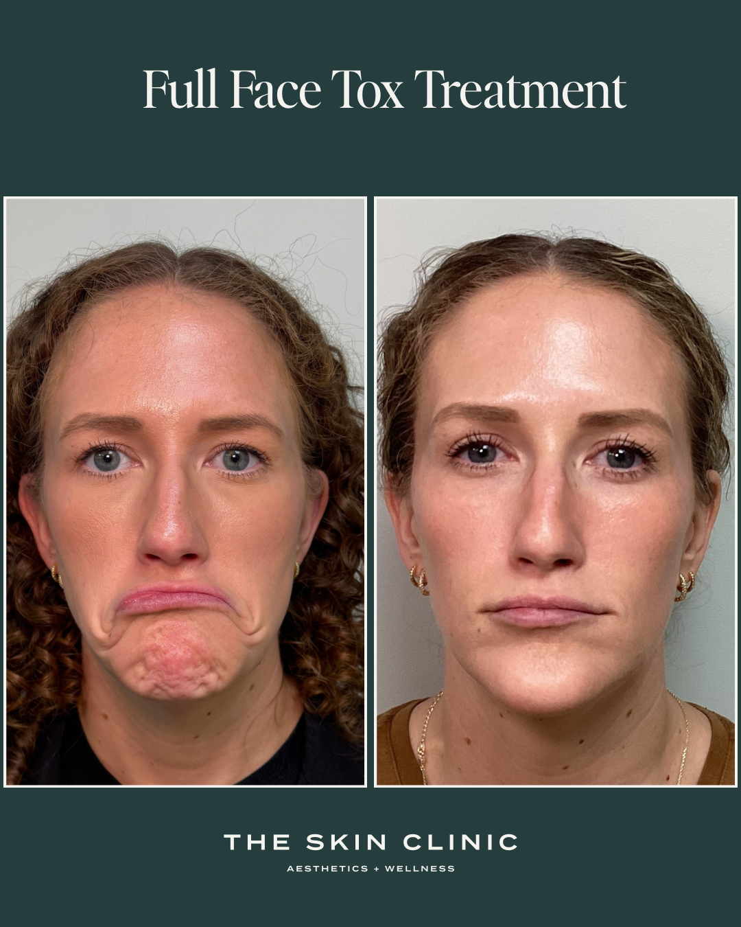 Botox lower face treatment 