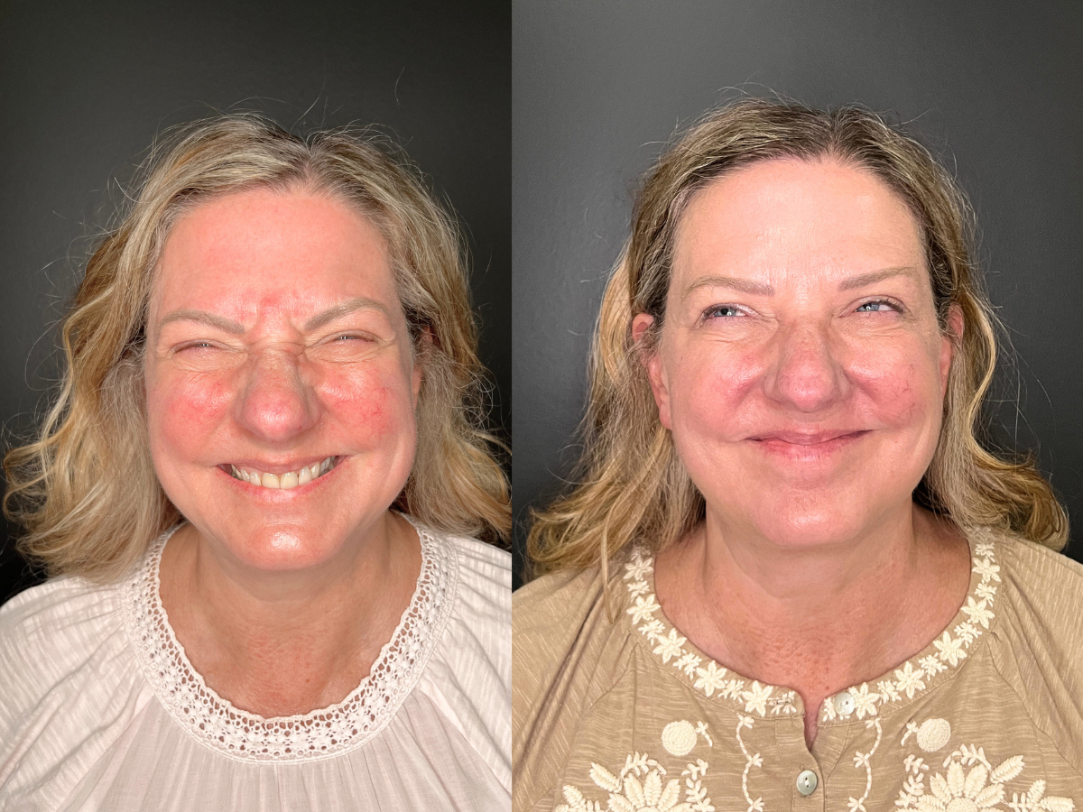 Side-by-side comparison of a woman before and after a cosmetic facial treatment, showing improved skin texture and tone.