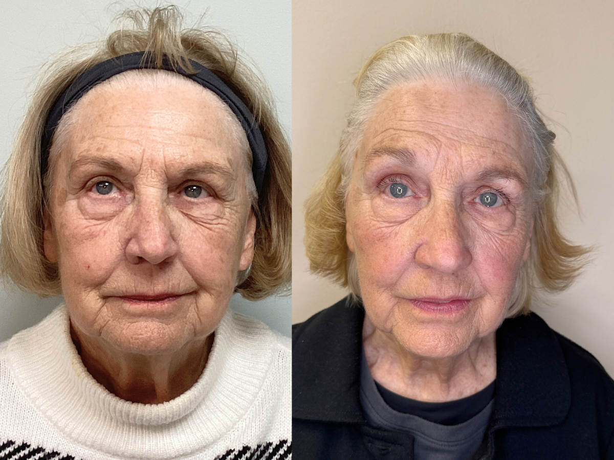 Side-by-side comparison of an elderly woman before and after a skincare treatment, showing improved skin texture and fewer wrinkles.
