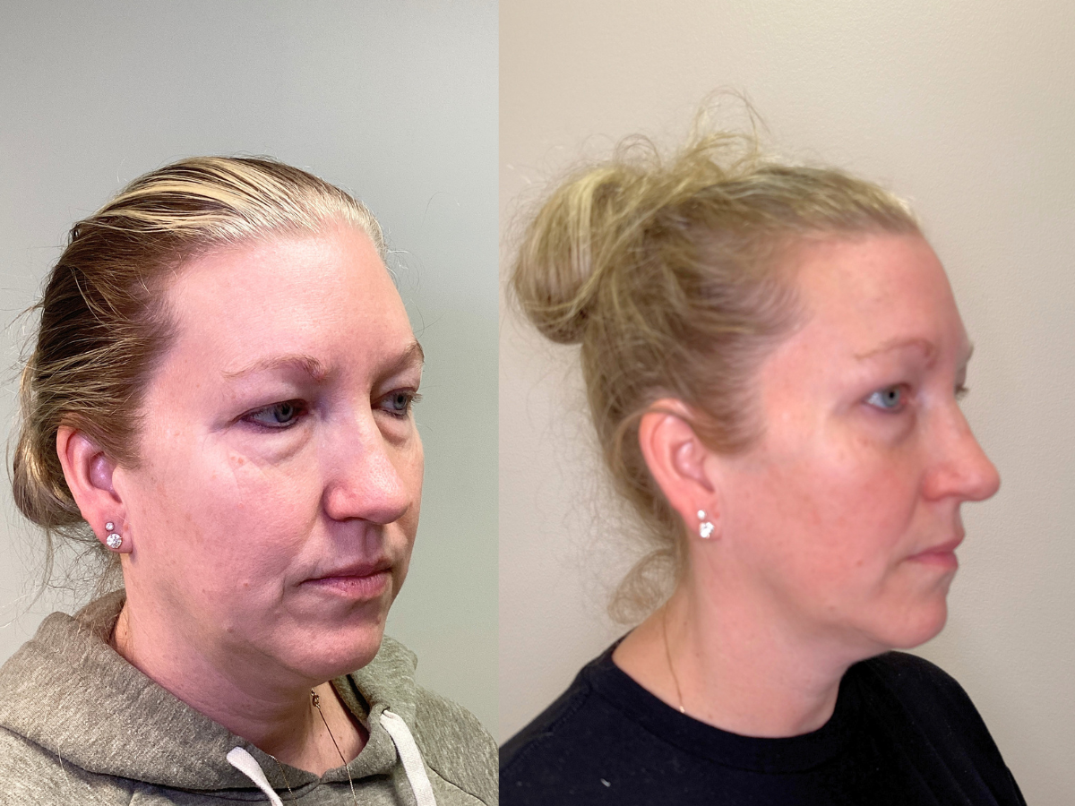 Comparison of a woman's face before and after cosmetic treatment, side profile views showing changes in skin and appearance.