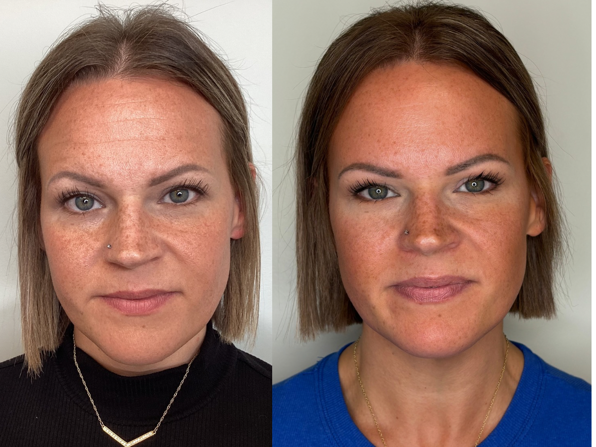Botox Treatment