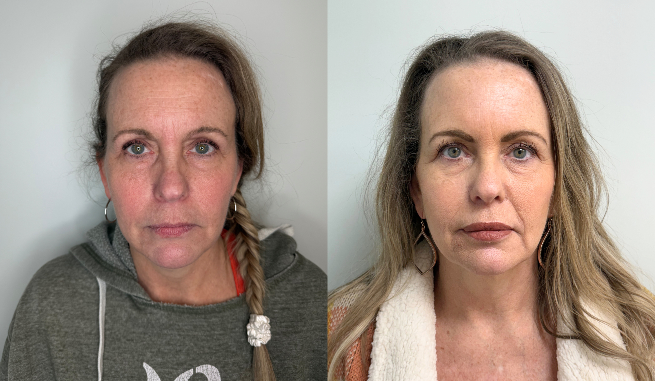 Side-by-side comparison of two women with similar facial features, both with fair complexion and blue eyes, showing before and after makeup or skincare improvements.