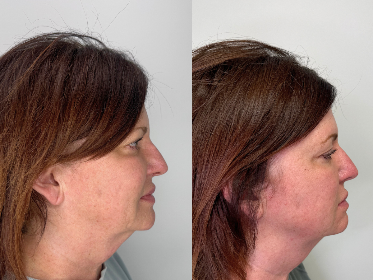 Side-by-side comparison of a woman before and after a cosmetic procedure, showing a reduction in facial fullness and a more defined jawline.