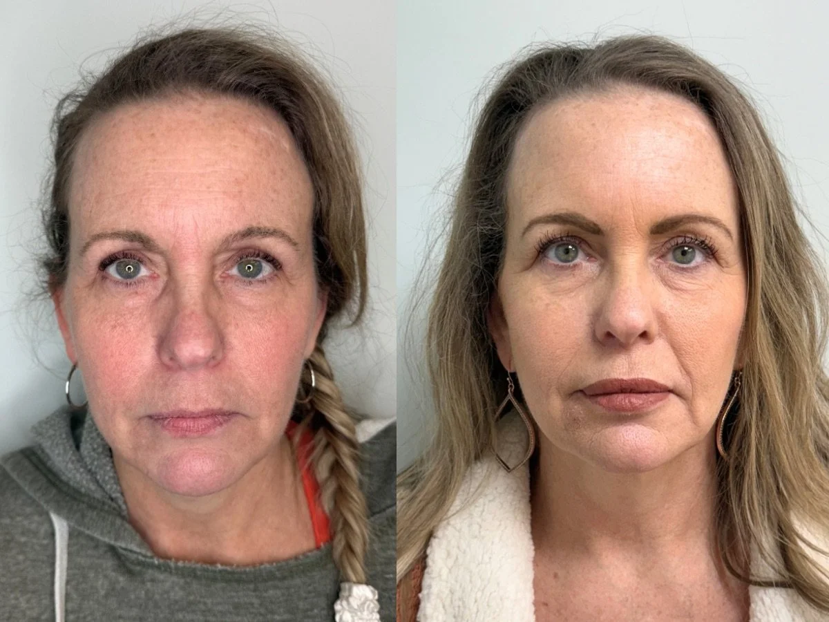 Side-by-side comparison of a woman's face before and after full face toxin treatment, showing smoother skin and reduced wrinkles.
