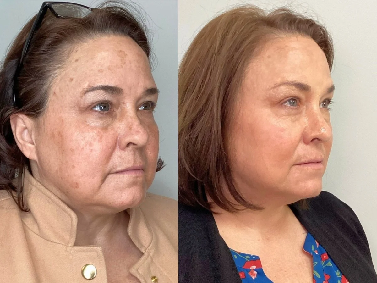 Laser Treatment Mankato, Mn