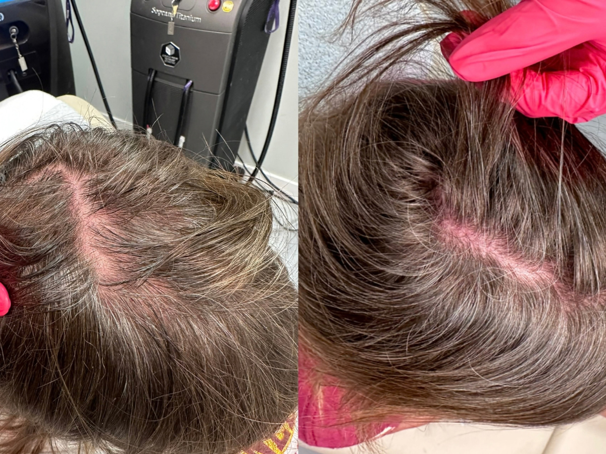 Side-by-side comparison of a person's scalp before and after hair treatment, showing improved hair density and scalp health.