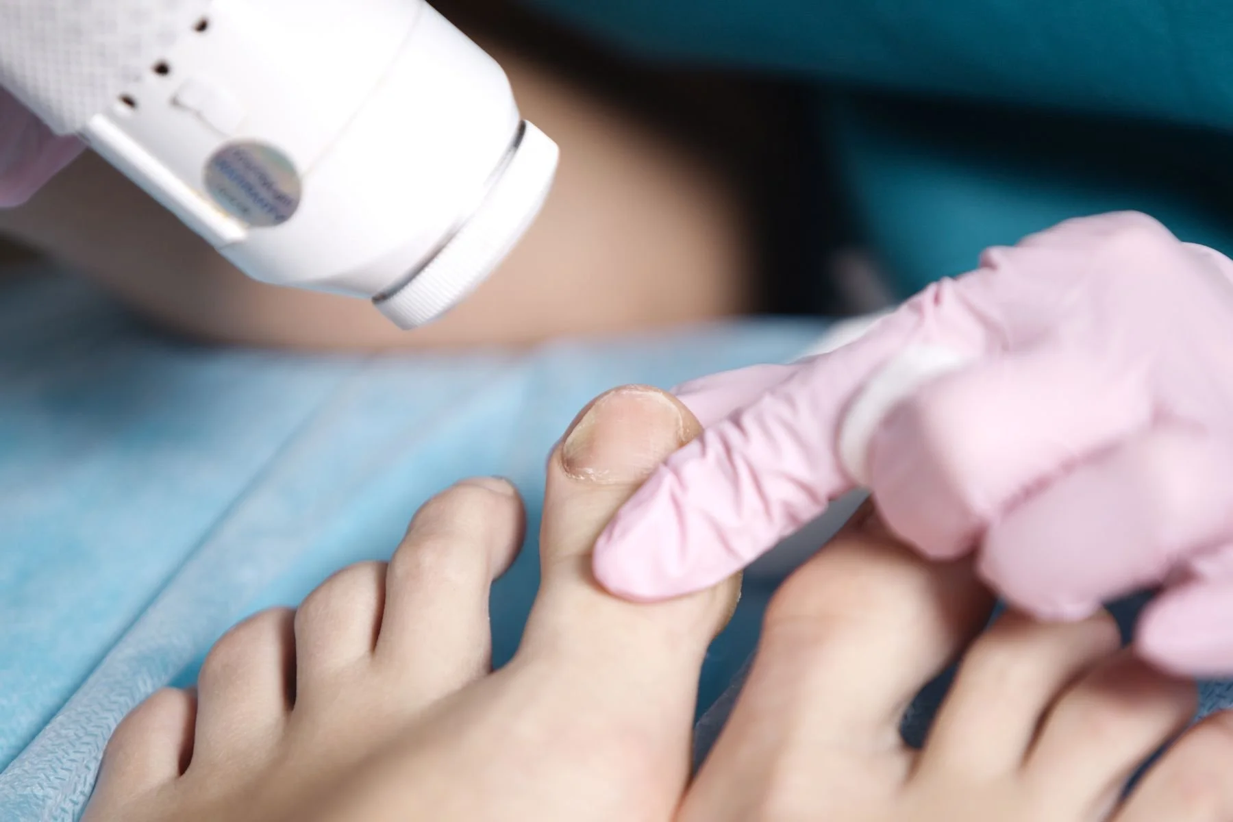 laser treatment for toenail fungus, mankato, mn