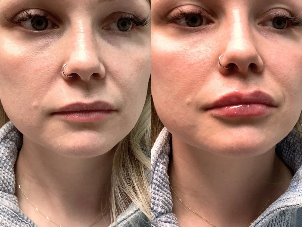 Botox treatment-eye wrinkles