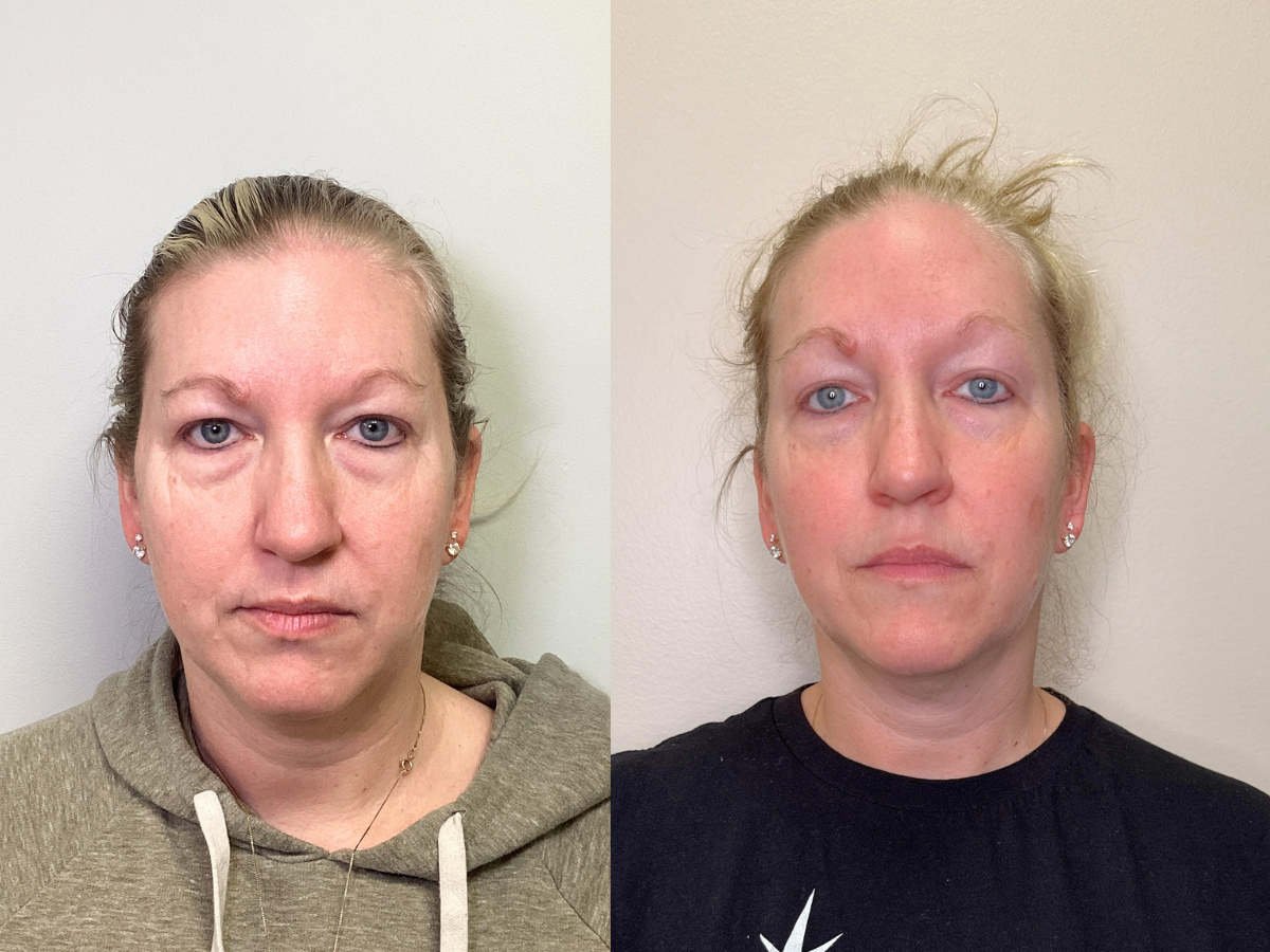 Side-by-side comparison of a woman before and after a skincare treatment, showing improved skin condition and reduced under-eye puffiness in the after photo.