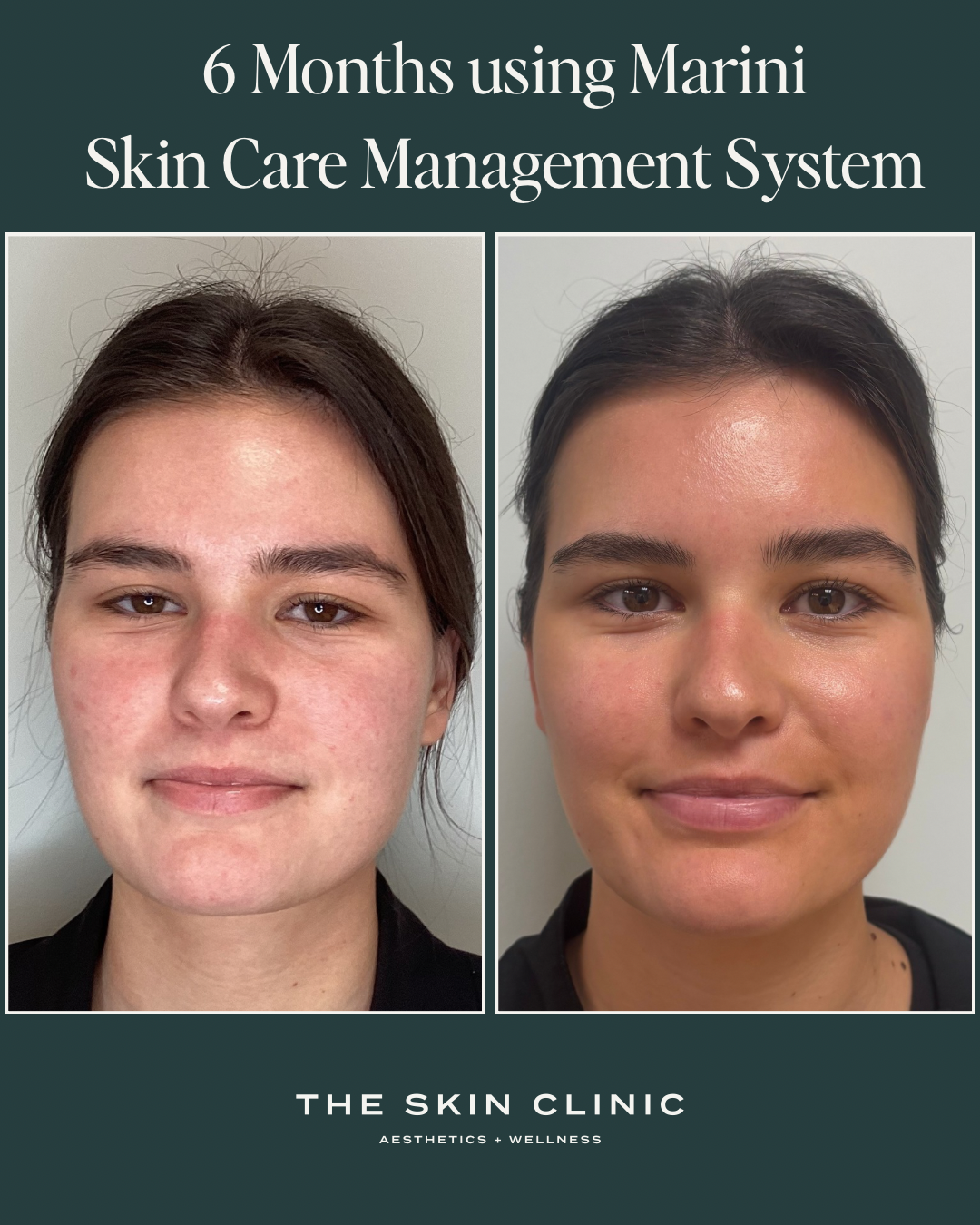 Side-by-side before and after photos showing skin improvement over 6 months with Marini Skin Care Management System at The Skin Clinic for aesthetics and wellness.